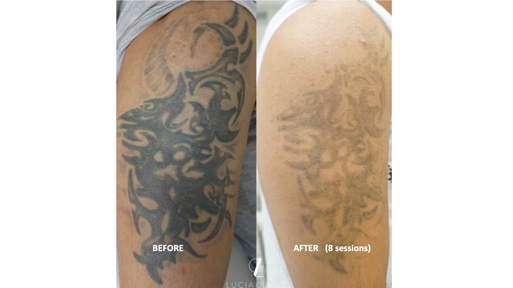 TATTOO REMOVAL PROCEDURE - MAKE THE UNWANTED INK GO AWAY