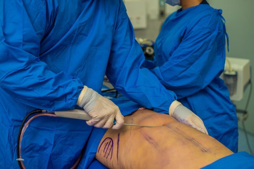 Liposuction plus fat grafting is a winning combination - get a double benefit by sliming one area of your body and adding volume to another area all at once.